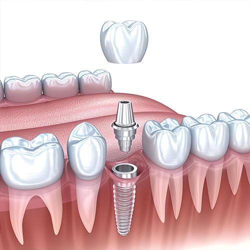 زراعة الأسنان بخبرة عالمية وتقنيات متطورة صفوة المهيدب خيارك الأول