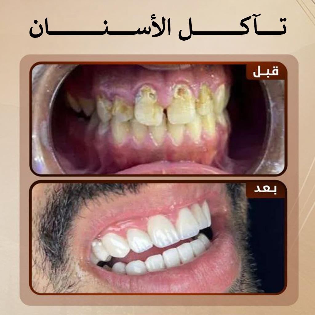 <p>تآكل الأسنان الأسباب والعلاج وكيف تحمي أسنانك</p>