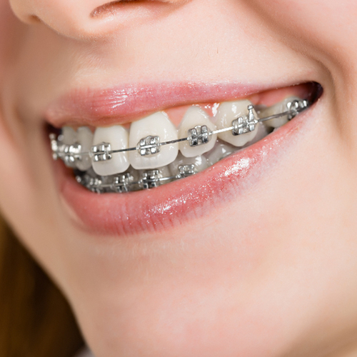 تقويم الاسنان