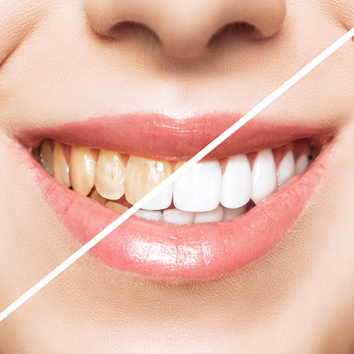 تبييض الاسنان